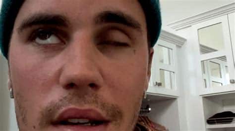 Justin Bieber CANCELS World Tour Over FACE PARALYSIS, Tour Canceled Over Rumor Ramsay Hunt Syndrome - Fringe News